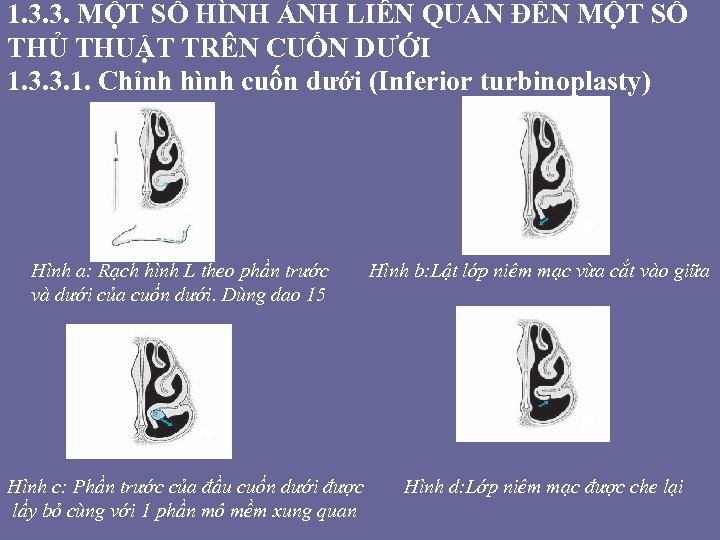 1. 3. 3. MỘT SỐ HÌNH ẢNH LIÊN QUAN ĐẾN MỘT SỐ THỦ THUẬT