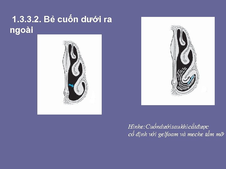 1. 3. 3. 2. Bẻ cuốn dưới ra ngoài Hình e: Cuốn dưới sau