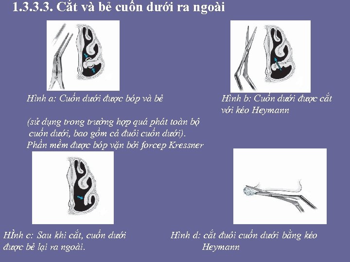 1. 3. 3. 3. Cắt và bẻ cuốn dưới ra ngoài Hình a: Cuốn