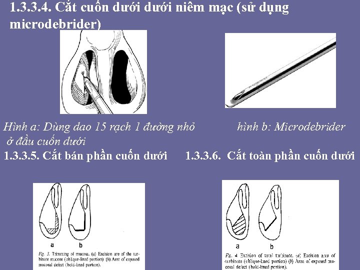 1. 3. 3. 4. Cắt cuốn dưới niêm mạc (sử dụng microdebrider) Hình a: