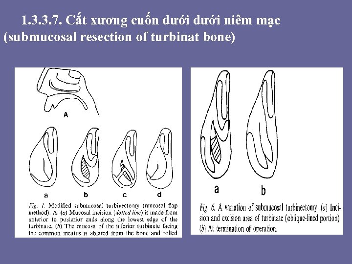 1. 3. 3. 7. Cắt xương cuốn dưới niêm mạc (submucosal resection of turbinat