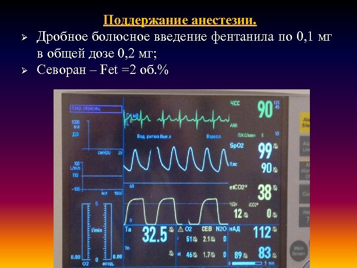 Болюсно. Дробное Введение. Дробное Введение лекарства. Болюсное дробное Введение это. Поддержание анестезии.