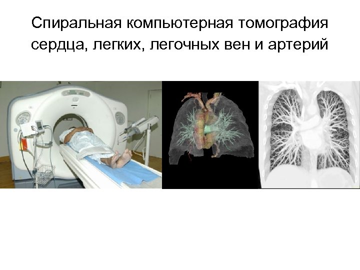 Спиральная компьютерная томография сердца, легких, легочных вен и артерий 38 