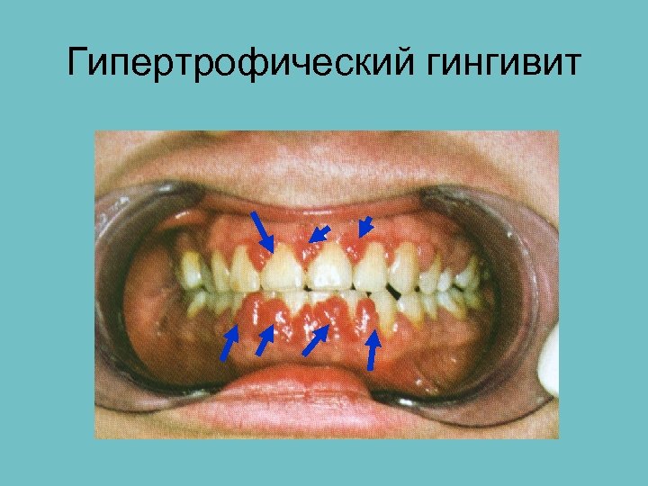 Гипертрофический гингивит 