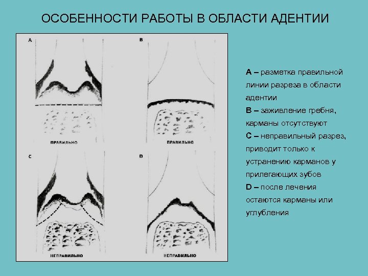ОСОБЕННОСТИ РАБОТЫ В ОБЛАСТИ АДЕНТИИ A – разметка правильной линии разреза в области адентии