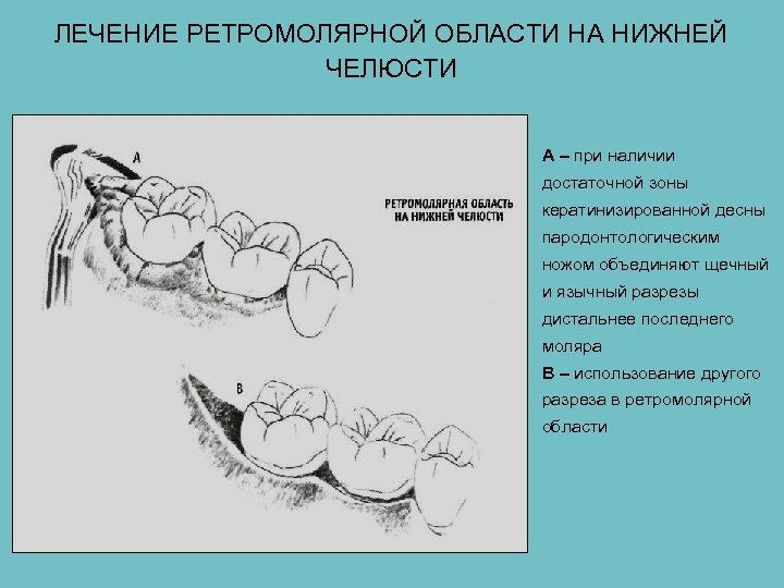 Полость подготовка. Периостит ретромолярного. Ретромолярное пространство абсцесс. Ретромолярный абсцесс верхней челюсти. Ретромолярная ямка нижней челюсти.