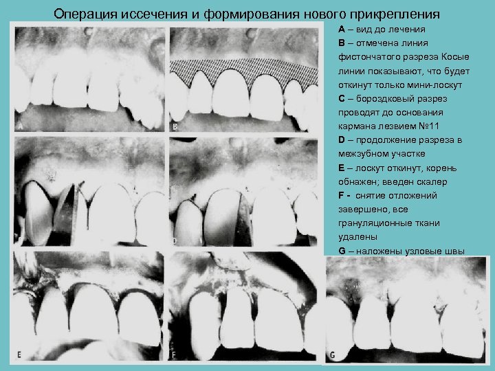 Общие принципы пародонтальной хирургии презентация