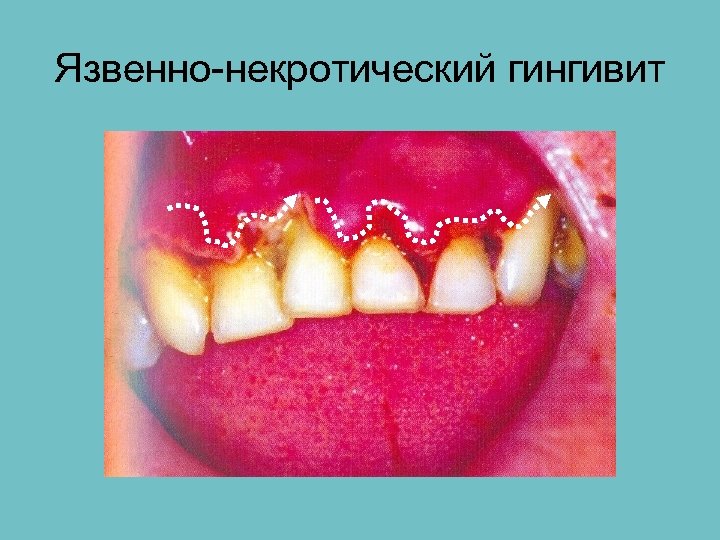 Язвенно-некротический гингивит 