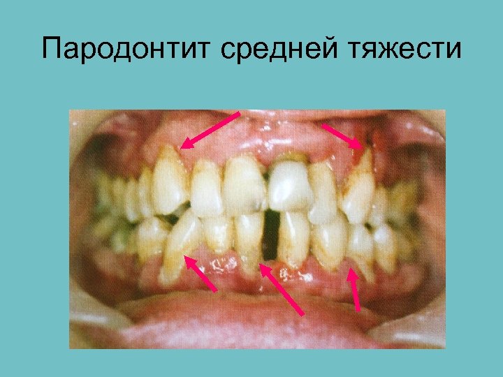 Пародонтальная карта онлайн