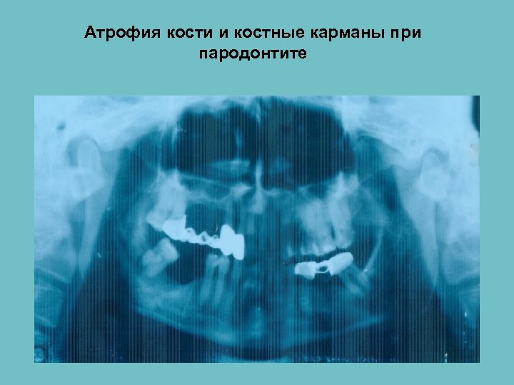 Атрофия кости и костные карманы при пародонтите 