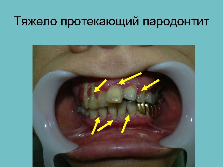 Тяжело протекающий пародонтит 