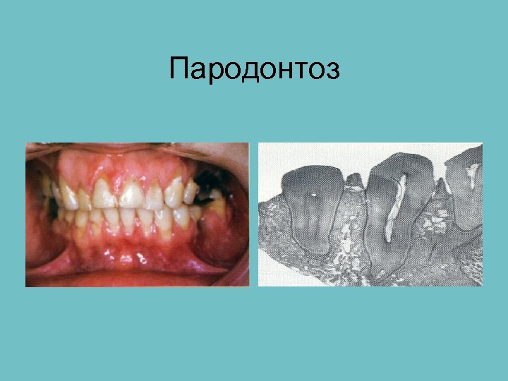 Пародонтоз 