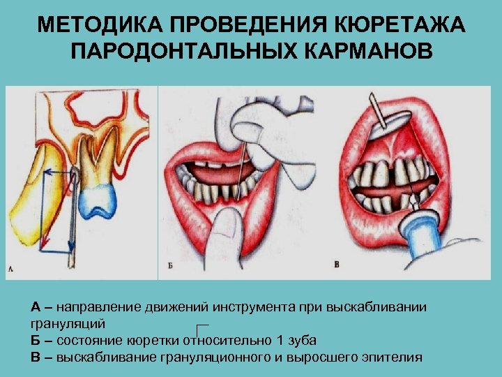 МЕТОДИКА ПРОВЕДЕНИЯ КЮРЕТАЖА ПАРОДОНТАЛЬНЫХ КАРМАНОВ А – направление движений инструмента при выскабливании грануляций Б