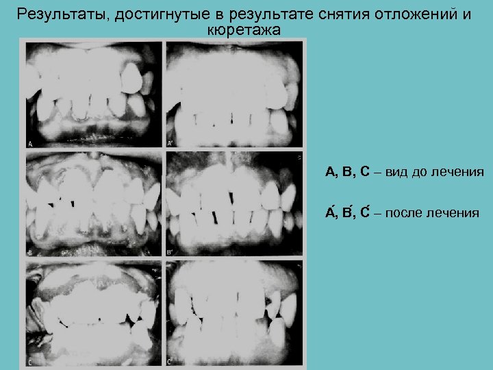 Результаты, достигнутые в результате снятия отложений и кюретажа А, В, С – вид до