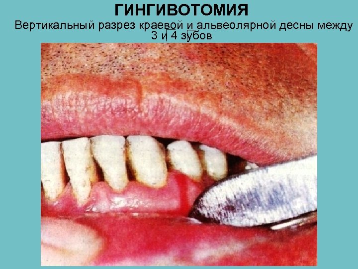 ГИНГИВОТОМИЯ Вертикальный разрез краевой и альвеолярной десны между 3 и 4 зубов 