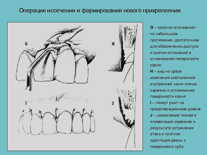 Общие принципы пародонтальной хирургии презентация