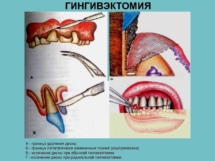 ГИНГИВЭКТОМИЯ А - граница удаления десны Б - граница патологически измененных тканей (заштриховано) В