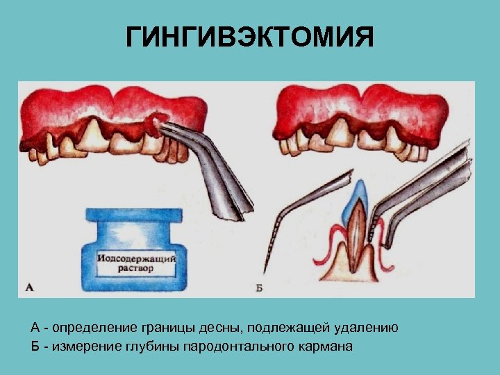 ГИНГИВЭКТОМИЯ А - определение границы десны, подлежащей удалению Б - измерение глубины пародонтального кармана