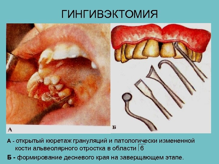 ГИНГИВЭКТОМИЯ А - открытый кюретаж грануляций и патологически измененной кости альвеолярного отростка в области