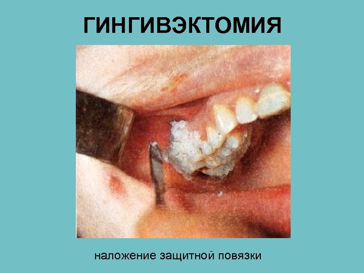 ГИНГИВЭКТОМИЯ наложение защитной повязки 