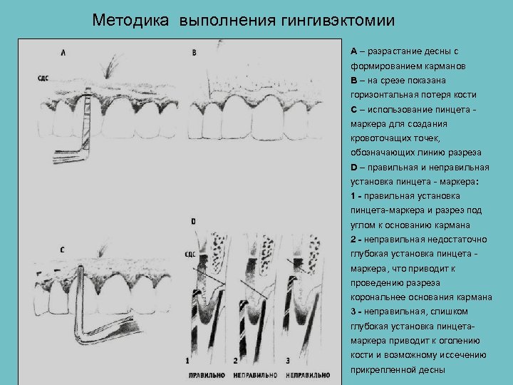 Общие принципы пародонтальной хирургии презентация