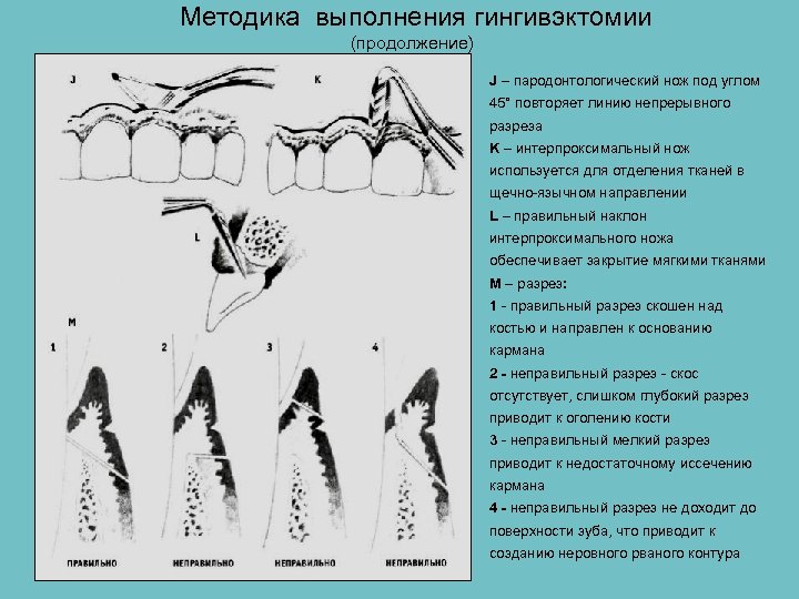 Методика выполнения гингивэктомии (продолжение) J – пародонтологический нож под углом 45° повторяет линию непрерывного