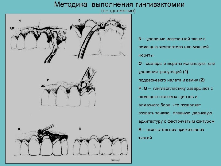 Методика выполнения гингивэктомии (продолжение) N – удаление иссеченной ткани с помощью экскаватора или мощной