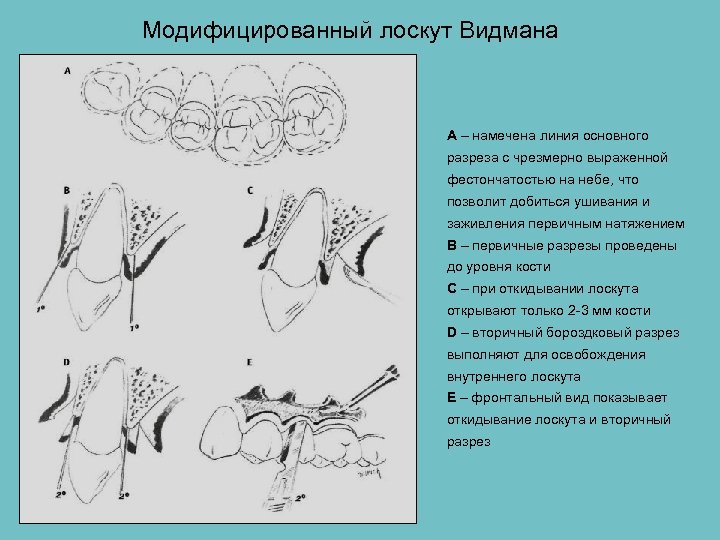 Общие принципы пародонтальной хирургии презентация