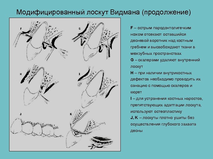 Модифицированный лоскут Видмана (продолжение) F – острым пародонтолигечким ножом отсекают оставшийся десневой воротник над