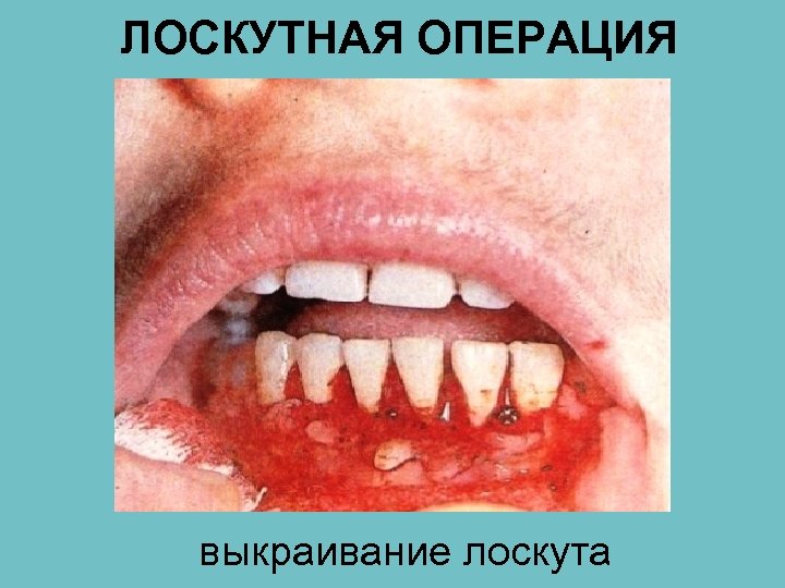 ЛОСКУТНАЯ ОПЕРАЦИЯ выкраивание лоскута 