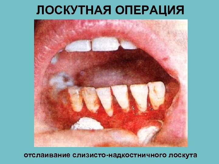 ЛОСКУТНАЯ ОПЕРАЦИЯ отслаивание слизисто-надкостничного лоскута 