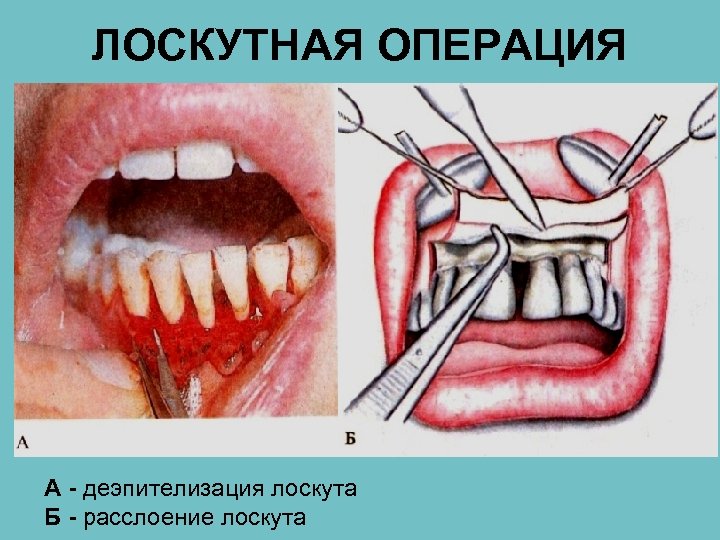 ЛОСКУТНАЯ ОПЕРАЦИЯ А - деэпителизация лоскута Б - расслоение лоскута 