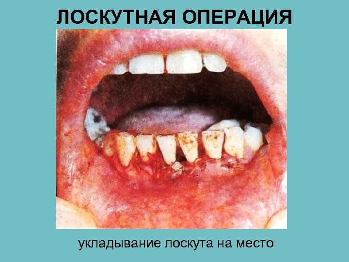 ЛОСКУТНАЯ ОПЕРАЦИЯ укладывание лоскута на место 