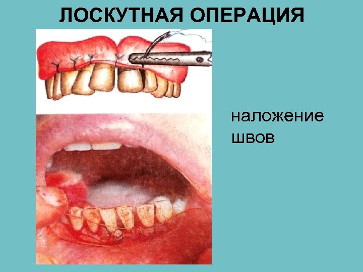 ЛОСКУТНАЯ ОПЕРАЦИЯ наложение швов 