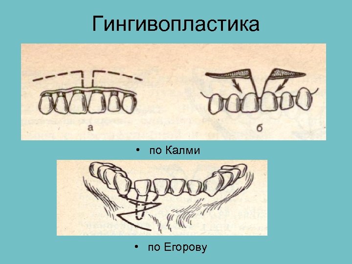 Гингивопластика • по Калми • по Егорову 