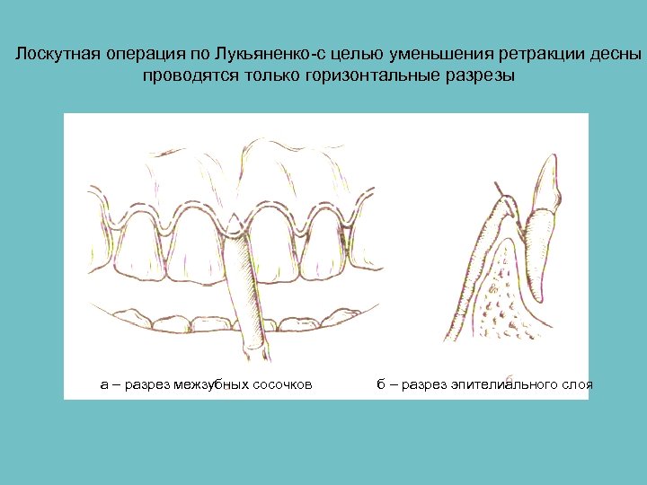 Лоскутная операция по Лукьяненко-с целью уменьшения ретракции десны проводятся только горизонтальные разрезы а –