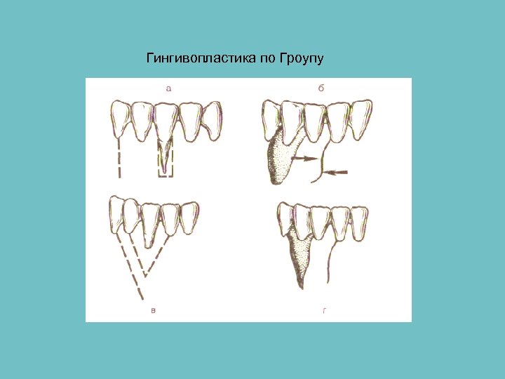 Общие принципы пародонтальной хирургии презентация