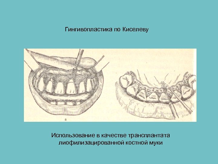Гингивопластика по Киселеву Использование в качестве трансплантата лиофилизацированной костной муки 