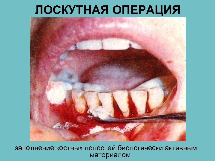 ЛОСКУТНАЯ ОПЕРАЦИЯ заполнение костных полостей биологически активным материалом 