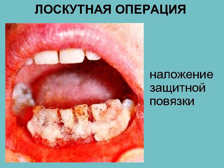 ЛОСКУТНАЯ ОПЕРАЦИЯ наложение защитной повязки 