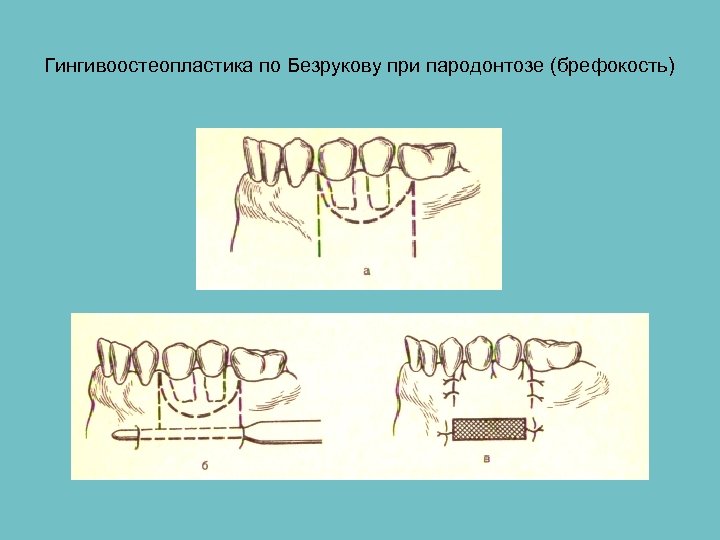 Гингивоостеопластика по Безрукову при пародонтозе (брефокость) 