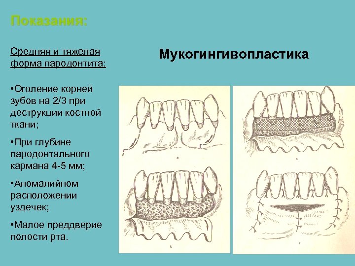 Общие принципы пародонтальной хирургии презентация