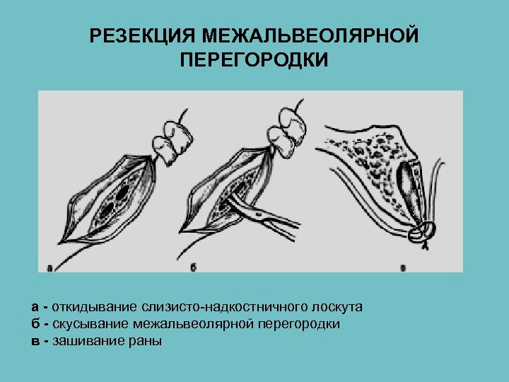 РЕЗЕКЦИЯ МЕЖАЛЬВЕОЛЯРНОЙ ПЕРЕГОРОДКИ а - откидывание слизисто-надкостничного лоскута б - скусывание межальвеолярной перегородки в