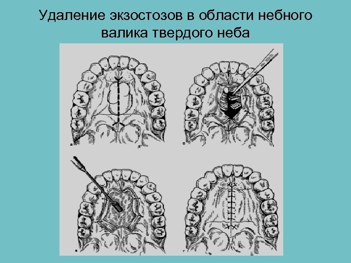 Удаление экзостозов в области небного валика твердого неба 