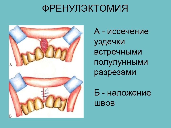 ФРЕНУЛЭКТОМИЯ А - иссечение уздечки встречными полулунными разрезами Б - наложение швов 