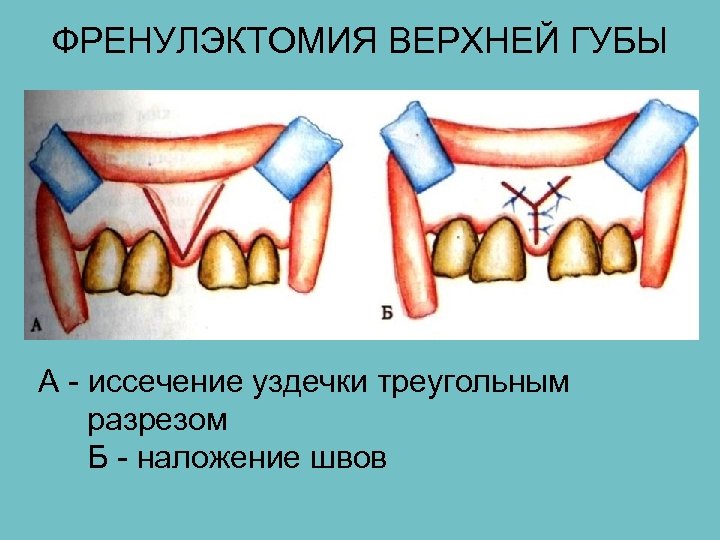 ФРЕНУЛЭКТОМИЯ ВЕРХНЕЙ ГУБЫ А - иссечение уздечки треугольным разрезом Б - наложение швов 