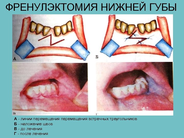 ФРЕНУЛЭКТОМИЯ НИЖНЕЙ ГУБЫ А - линии перемещения встречных треугольников Б - наложение швов В