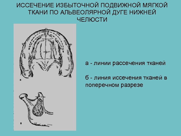 Полость готовиться