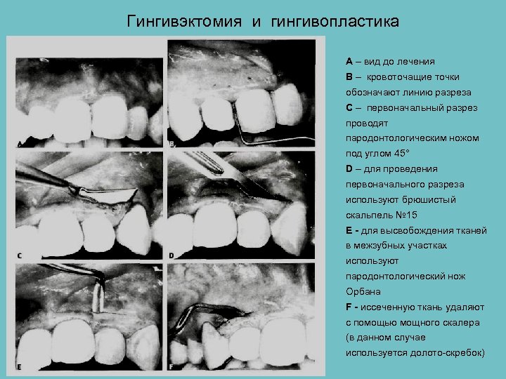 Общие принципы пародонтальной хирургии презентация