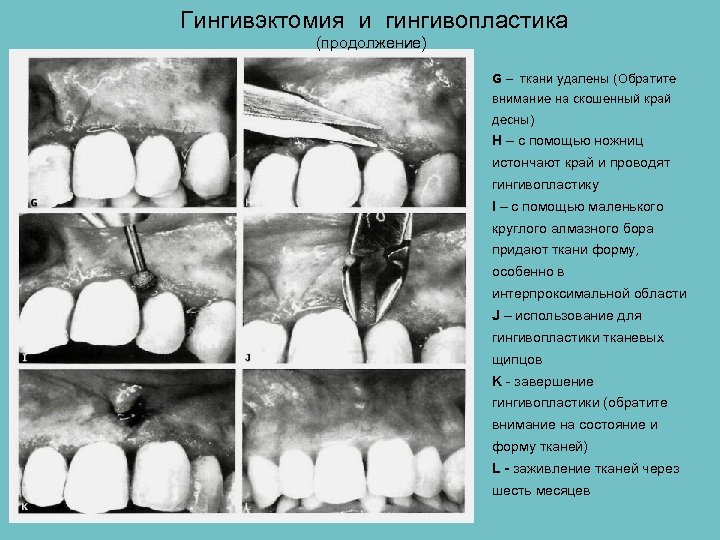 Гингивэктомия и гингивопластика (продолжение) G – ткани удалены (Обратите внимание на скошенный край десны)